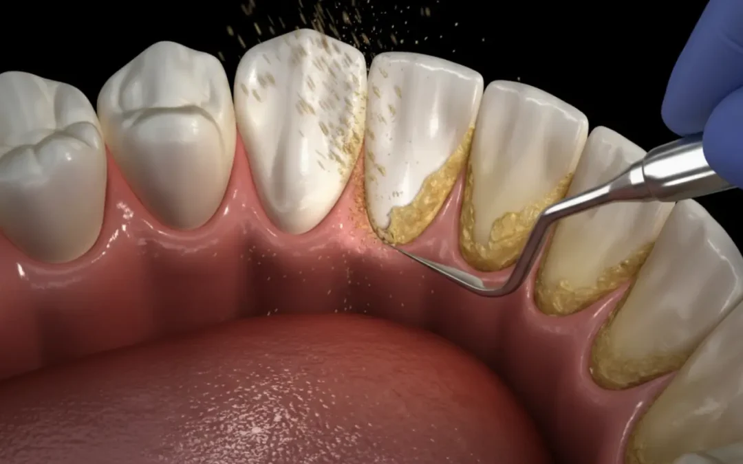 Diş Taşı Temizliği Periodontolojide Neden Önemli?